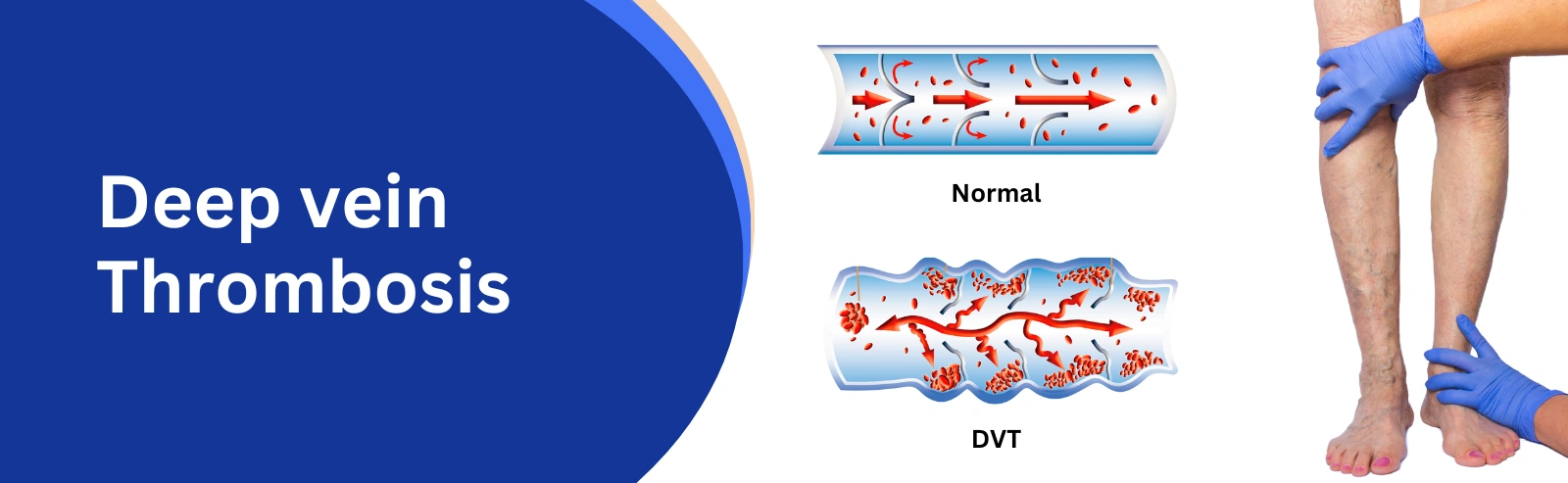 Deep_vein_thrombosis_title_image